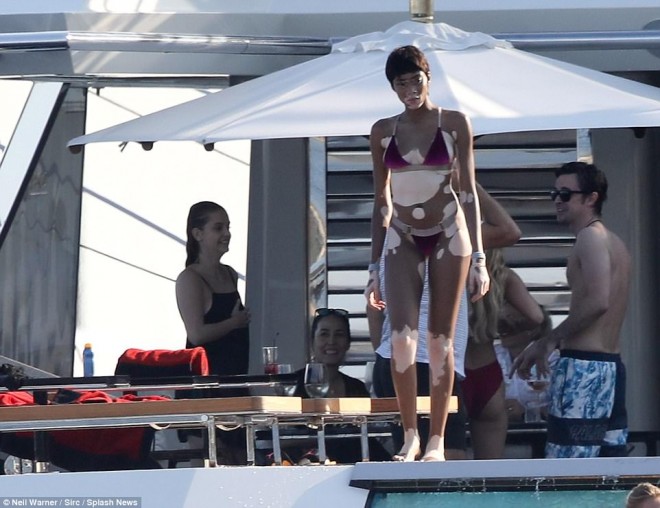 Vitiliqo xəstəliyindən əziyyət çəkən model Monakoda dicəlir