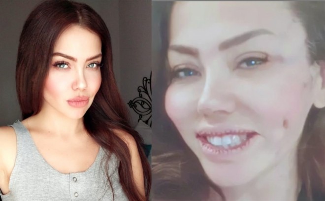 &nbsp;Lara dodağına 30&nbsp;tikiş vurdurdu - foto