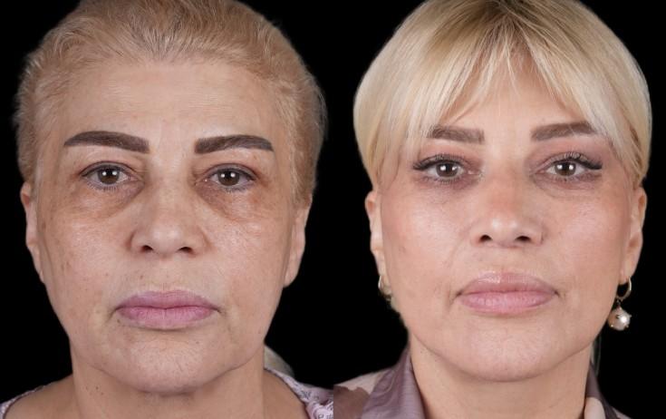 Əməkdar artist xeyli gəncləşib - FOTO